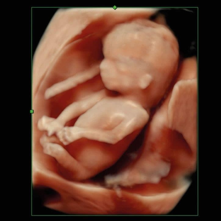 Nicht-invasiver Pränataltest